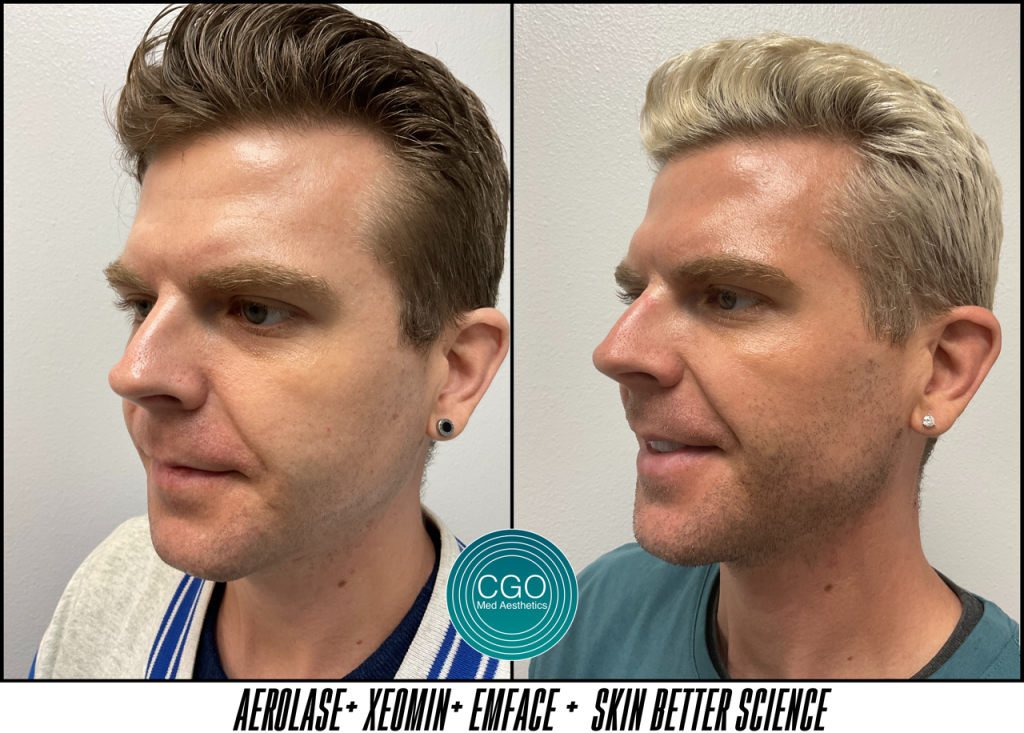 69a1bd4a5e39a3f0016f1ec5 Copy Of Before Afters First Gallery 101077 - Aesthetic Clinic San Diego