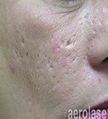 Before Aerolase Era acne scar treatment