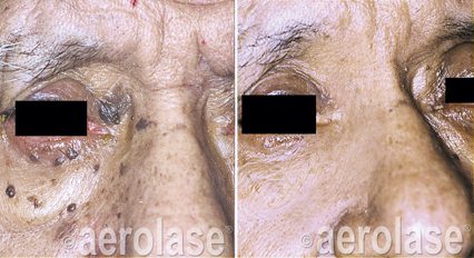 Cutaneous lesion before and after Aerolase Era treatment