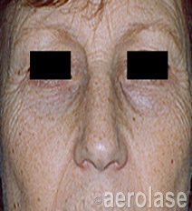 Before Aerolase Era medium depth ablation treatment